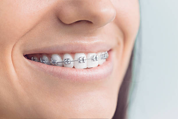 Dental Bonding in Brookville, OH